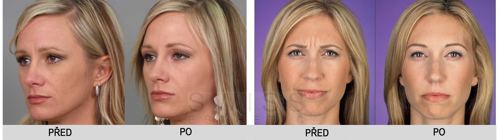 Co udělá Botox?