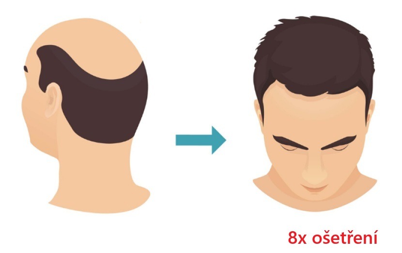 Laserová liposukce Verjú