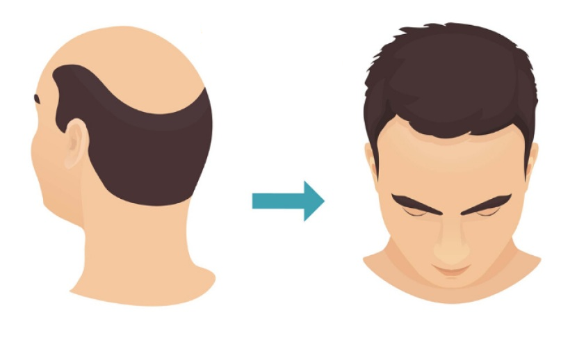 Laserová liposukce Verjú